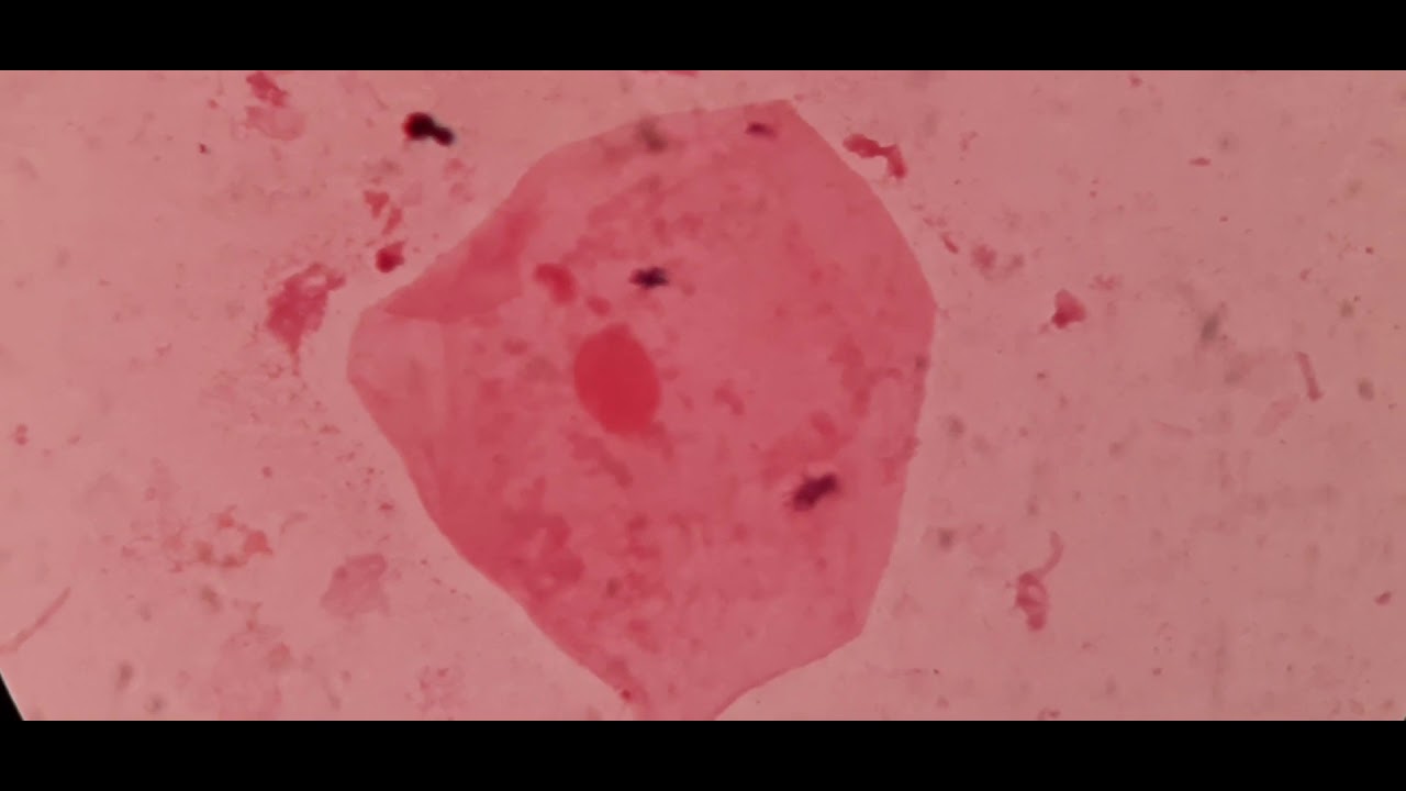 Yeast cells, pus cells  pseudohyphae and epithelial cells under the microscope