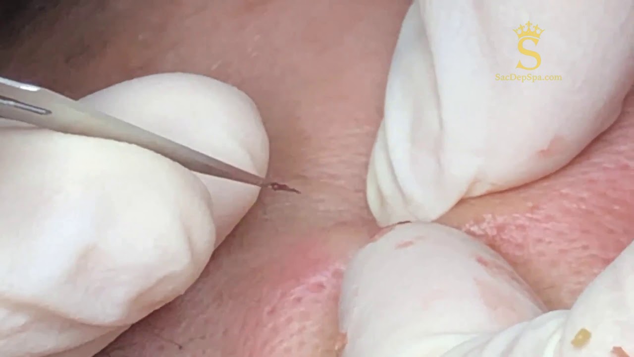 Lấy Mụn Ẩn Dể Dàng
