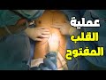 شاهد كيف تتم عملية القلب المفتوح                                              نجومي
