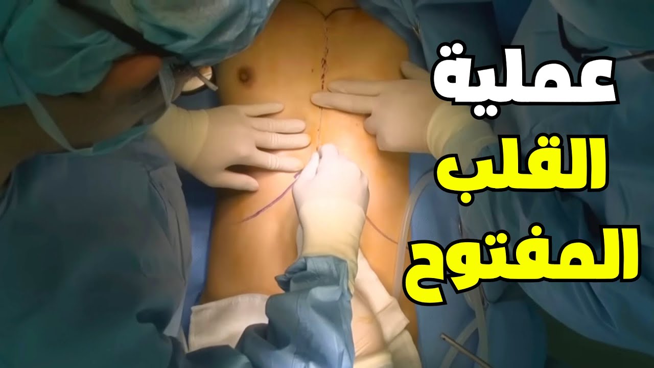شاهد كيف تتم عملية القلب المفتوح _ open heart surgery (Heart Bypass Surgery)