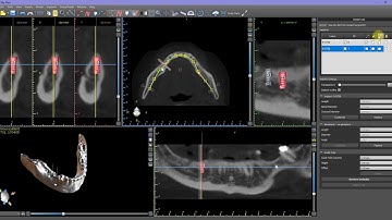 How Can I Hide an Overlapping Implant