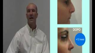 Rinoplastica Con Innesto Cartilagine Nella Punta - Dr. Enrico