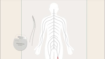 Boston Scientific - How SCS Works