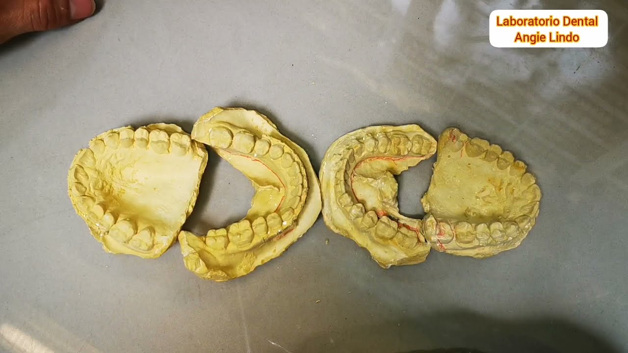 Análisis de modelos dentales