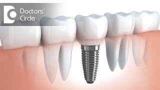 How long do implants last? - Dr. Sharon Colaco Dias