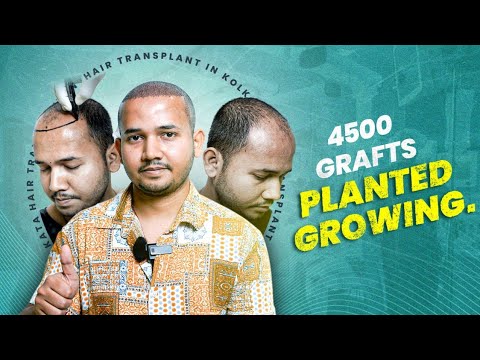 Was It Painful? My Real Hair Transplant Experience 😊 | Kolkata | New Roots