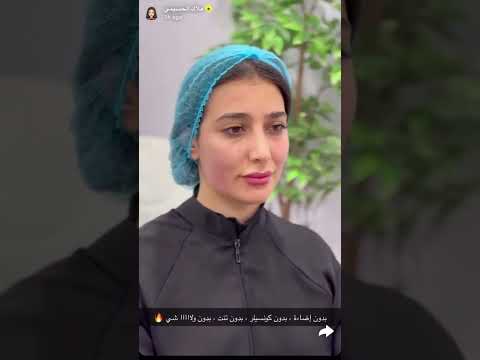 نتيجة جلسة شد مائي للوجه بدون اي امتلاء وتغطية حصرية للدكتورة ملاك الحسيني