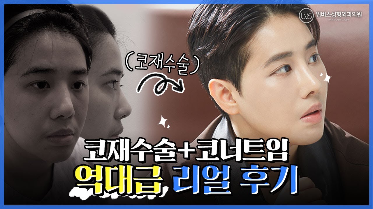 [Вэвэрс гоо сайхны мэс заслын клиник] Хамар дахин мэс засал ба хамрын угалз засах мэс заслын 2 долоо хоногийн дараах бодит сэтгэгдэл 💖