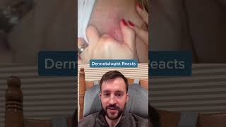 Dermatologist reacts to cyst pop