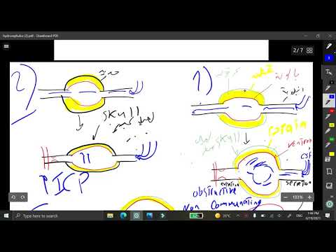 hydrocephalus ਦੀ ਦਰ