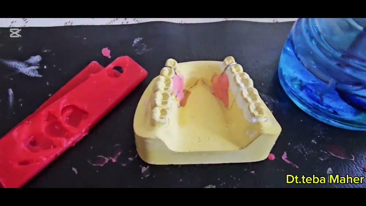 Waxing and making bite rim of partial cast