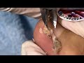 Ep_6675 Foot nails skin removal 👣 เล็บแบบนี้..ไม่มียาวออกมา 😄 (clip from Thailand)