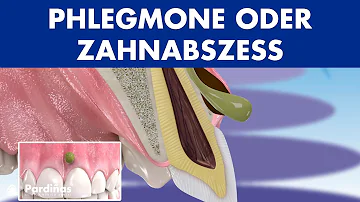 Welches Antibiotikum bei Abszess Zahn?