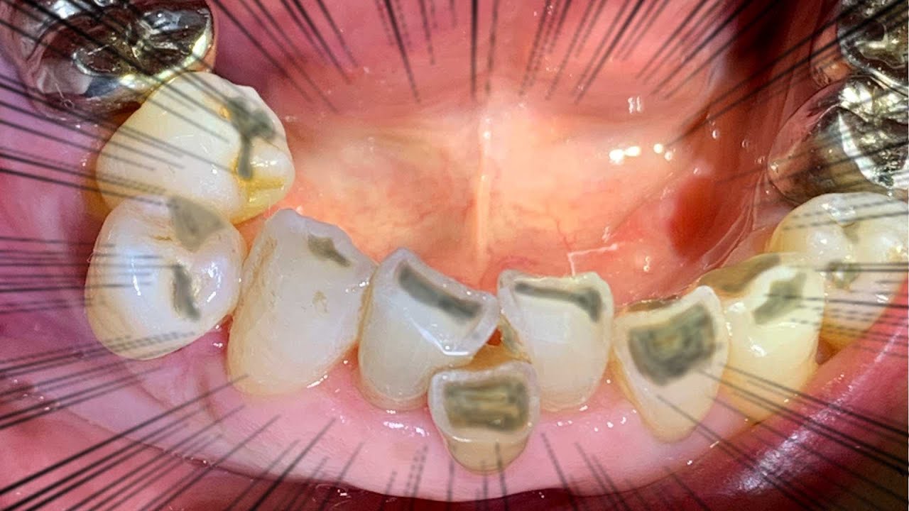 虫歯 だらけ の 歯