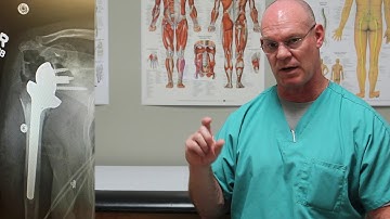 Proximal Humerus Fracture | Fracture Friday Episode 17