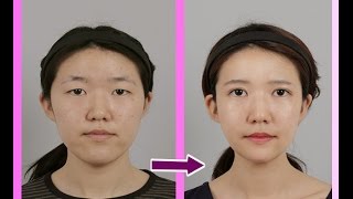 眼瞼下垂手術 - 視界改善と美しい目元形成 : id美容外科