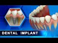 Dental implant in advanced procedure in 3d animation by curveia