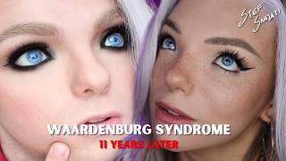 WAARDENBURG SYNDROME - 11 years later | Stef Sanjati