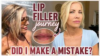 Lip Filler at 52 ~ Photos/Videos of Healing Process ~ Did I Make a Mistake?