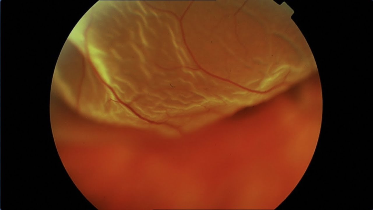 Le décollement de la rétine: mouches volantes, éclairs de lumière et voile noir