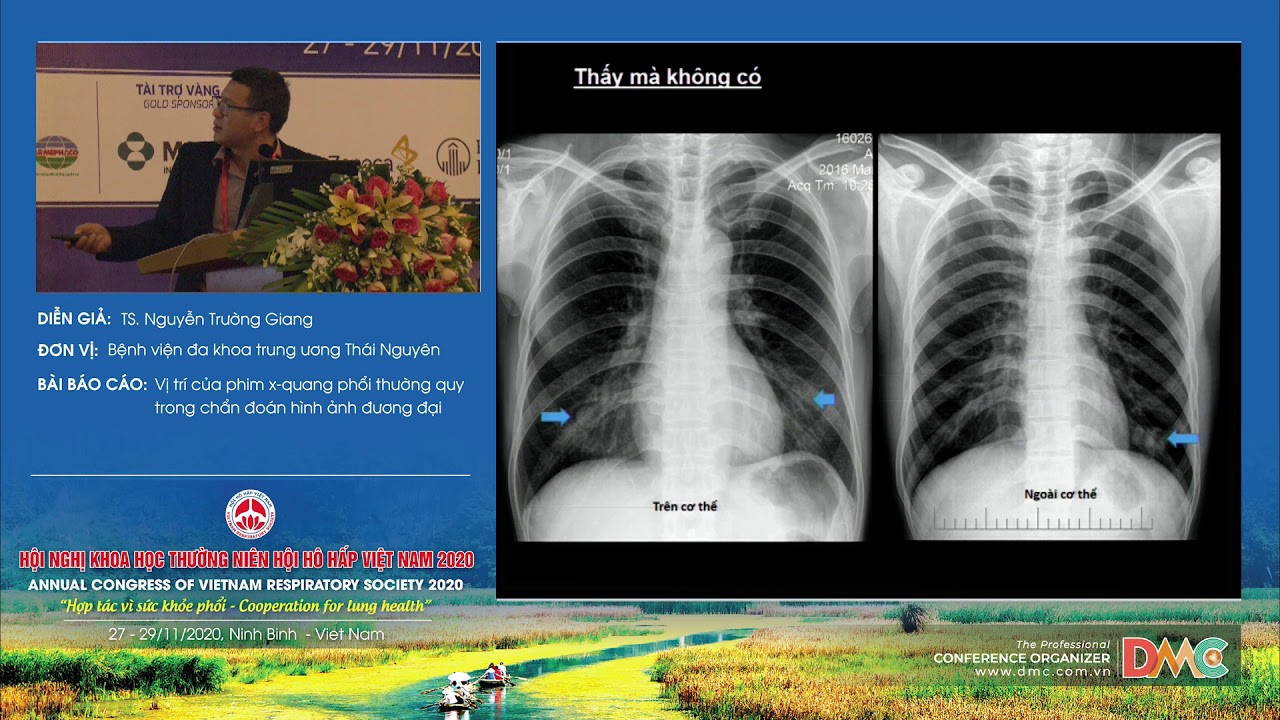Vị trí của phim x-quang phổi thường quy trong chẩn đoán hình ảnh ...