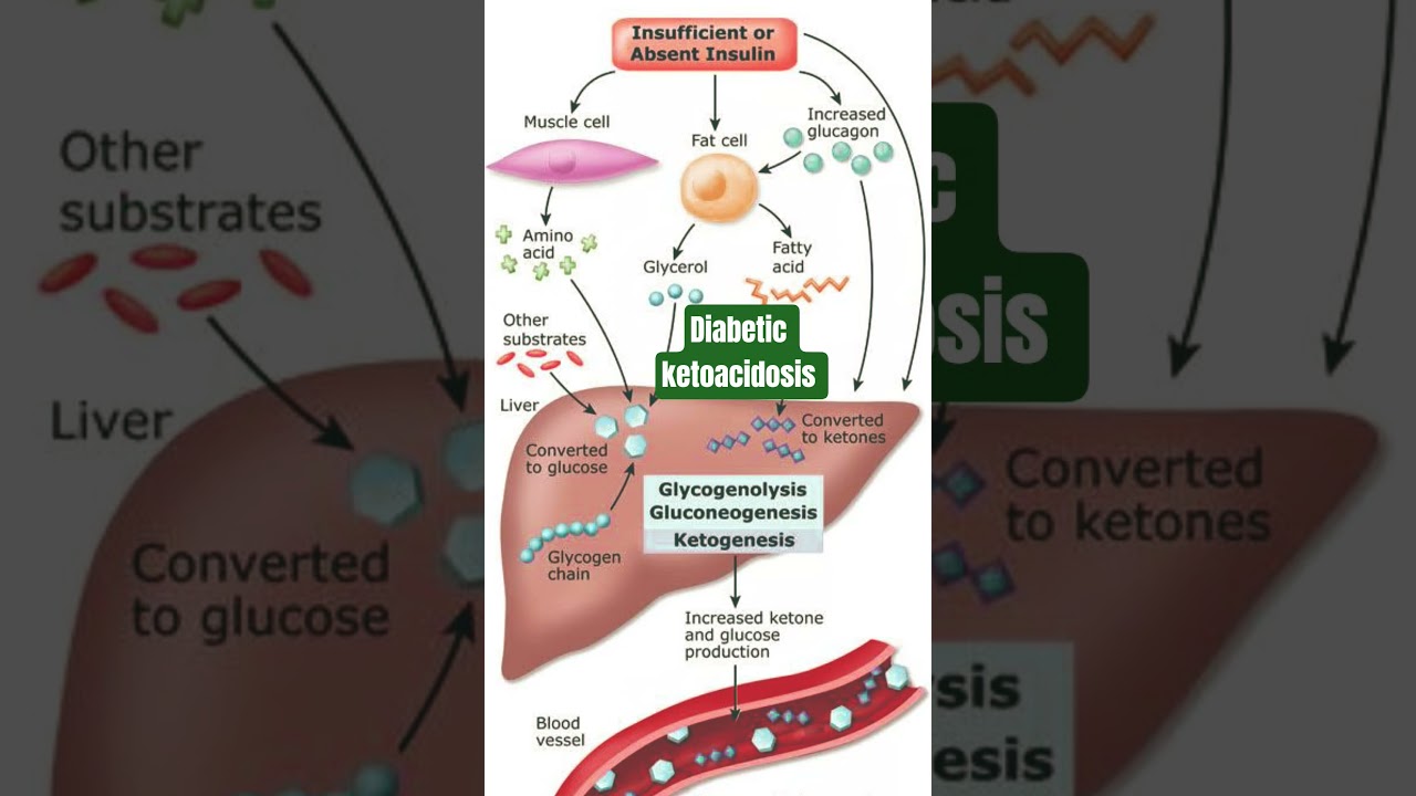 diabetic ketoacidosis #dka #diabeticketoacidosis #diabetes #diabetic #diabeticos #insulin #glucagon