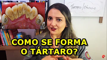 Quanto tempo leva para formar tártaro nos dentes?