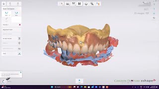 CUD-CPLD Intraoral Scan
