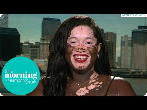 I'm a Black Woman Slowly Turning White | This Morning 