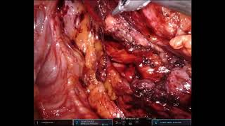 Robotic pyeloplasty on the right side   Part08