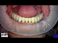 Виниры для зубов. Установка виниров на нижнюю челюсть. Dental veneers. 牙貼面。