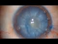 White cataract double rhexis  catarata intumescente  retina center tijuana dr aureliano moreno