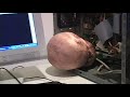 mechanical tumor