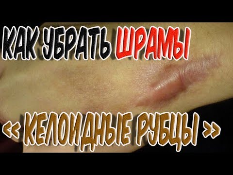 ➤Здоровье➤Как убрать шрамы, Келоидные рубцы ➤