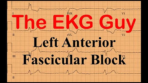 EKG/ECG Practice 65.0 - Left Anterior Fascicular Block | The EKG Guy