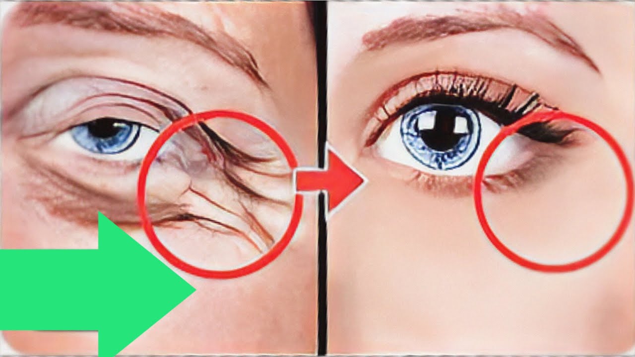 How to Get rid of Under Eye wrinkles?. Reduce Wrinkles. How to Treat ...