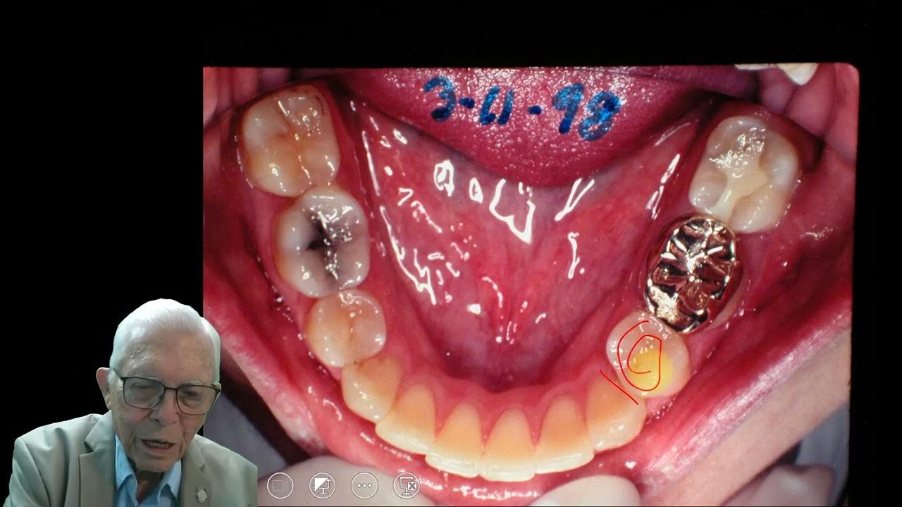 Full Treatment of A Complex TMJ Case Part 4 YouTube