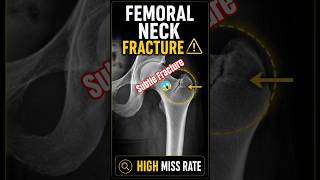 “Hip Fracture Spotting 😳”#Orthopedics #Fracture #Radiology #XRay #Learning