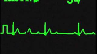 2nd Degree Type I AV Block - ECG Simulator - Arrhythmia Simulator