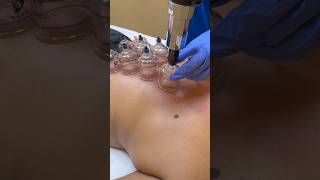 Cupping therapy for improving circulation