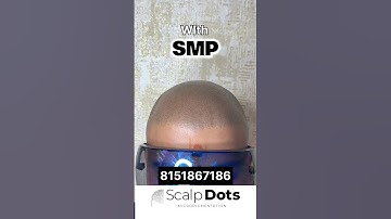 Smp for density buildup after hair transplant #scalpmicropigmentation #smp #scalpdots