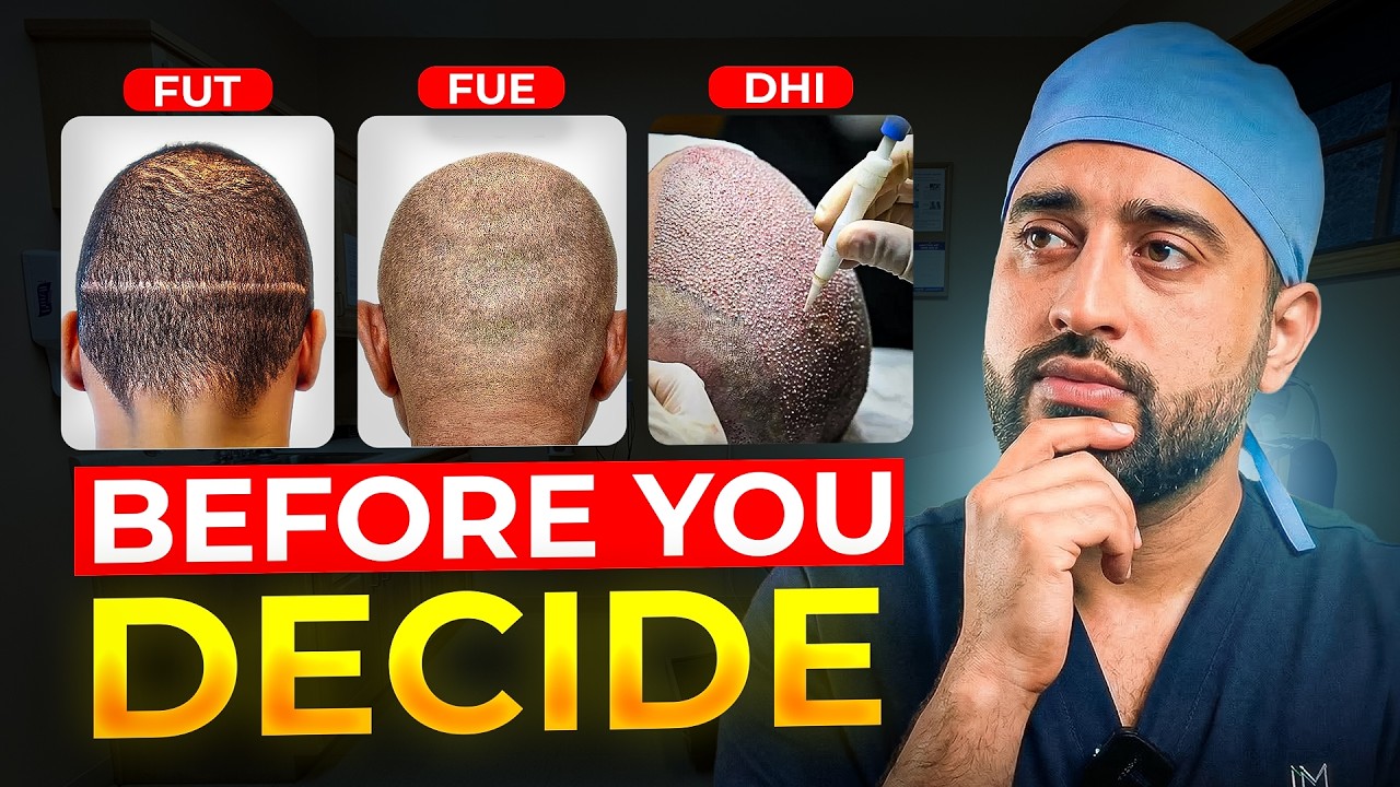 Why I choose FUE Hair Transplants over FUT & DHI (watch before you book)