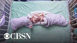 How doctors separated twin girls conjoined at the brain