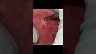 The Cleanest Cyst Pop Youll See Today