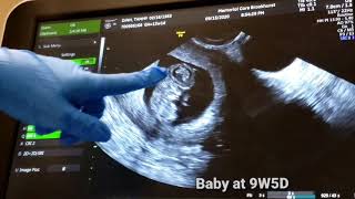 9W5D Ultrasound | baby is having a show for us to see.