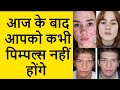 Acne  pimples remove tips by indian boy kk 