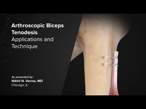 Arthroscopic Biceps Tenodesis: Applications and Technique