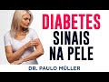 Sinais de diabetes que aparecem na pele  dr paulo mller dermatologista