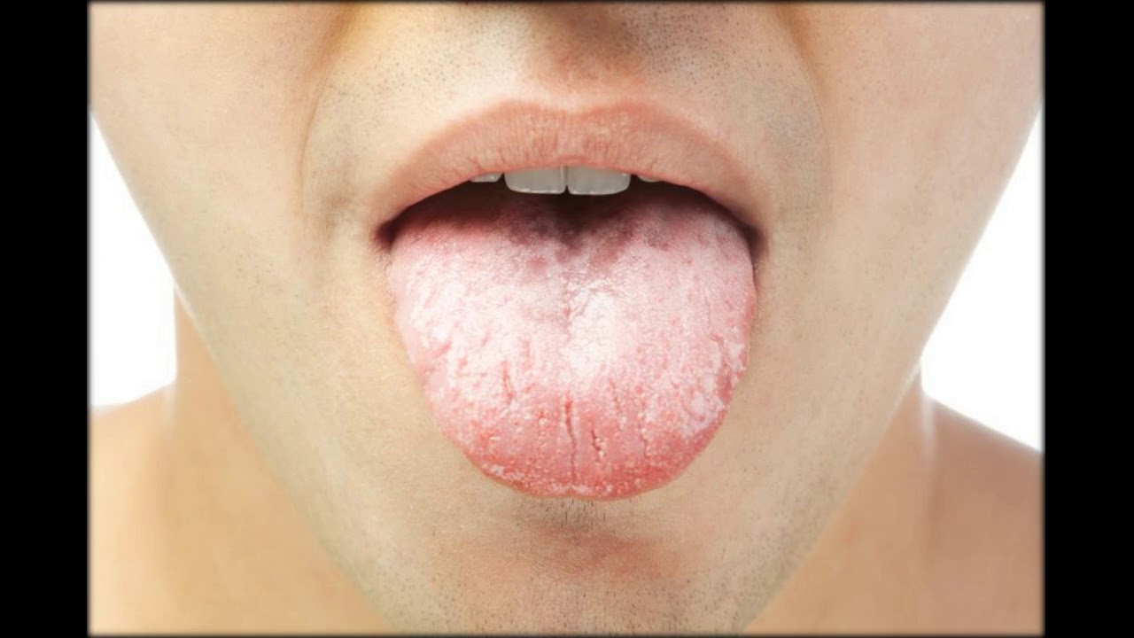 Was hilft bei einer Seitenstrangangina? Symptome und Therapie YouTube