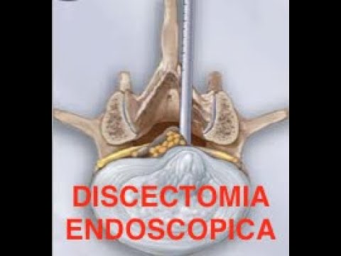 DISCECTOMIA ENDOSCOPICA INTERLAMINAR L5-S1